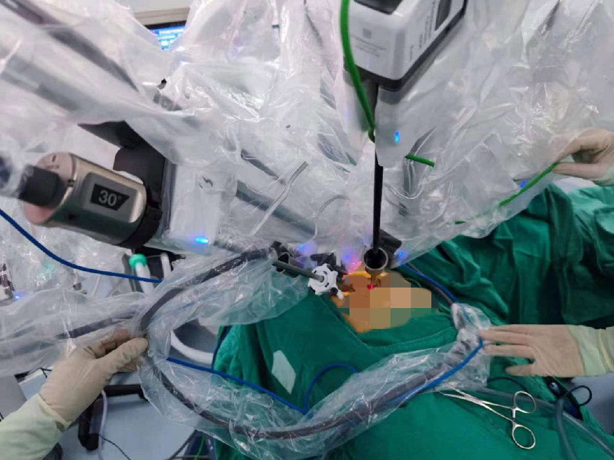 心胸血管外科完成科室首例达芬奇机器人单孔手术