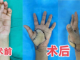 急诊科北院院区助疤痕挛缩患者恢复手部功能