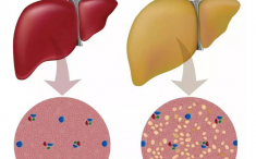 一起呵护小心“肝”之体检发现脂肪肝，该怎么办？